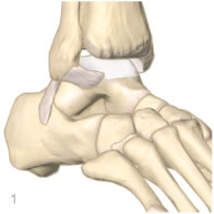 cheville microfractures