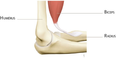 coude rupture distale biceps