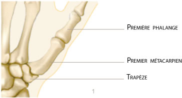 main rhizarthrose