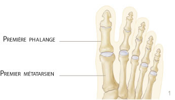 pied hallux rigidus