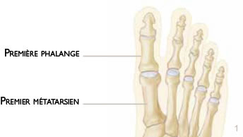 pied hallux valgus